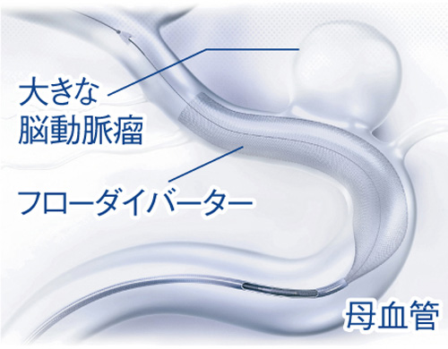 フローダイバーターステント治療