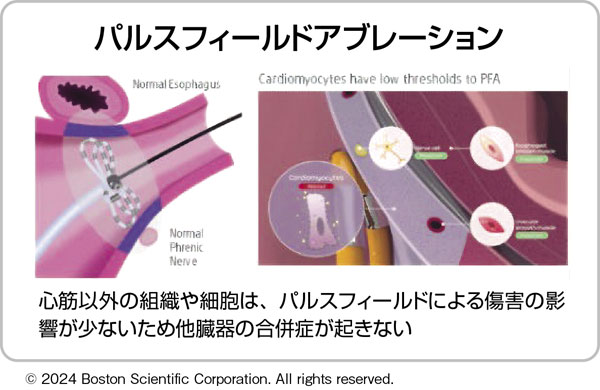 パルスフィールドアブレーション