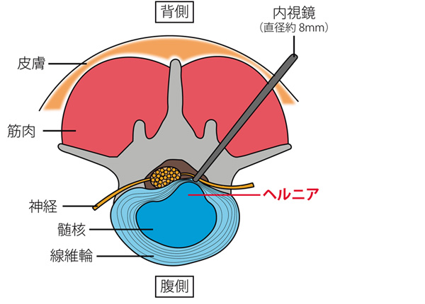 FESS(完全内視鏡下脊椎手術)のイメージ図