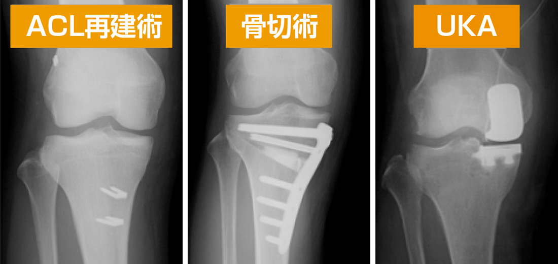 左から、前十字靭帯再建術、膝周囲骨切り術、人工膝関節単顆置換術のレントゲン写真。専門性の高い膝関節治療を提供している